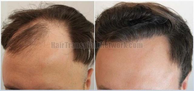 Left view before and after hair transplant surgery