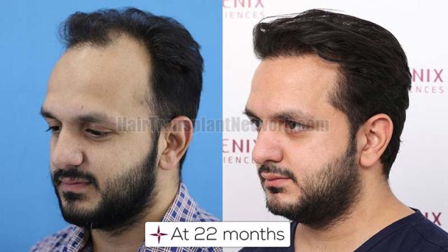 Left view before and after hair transplant surgery