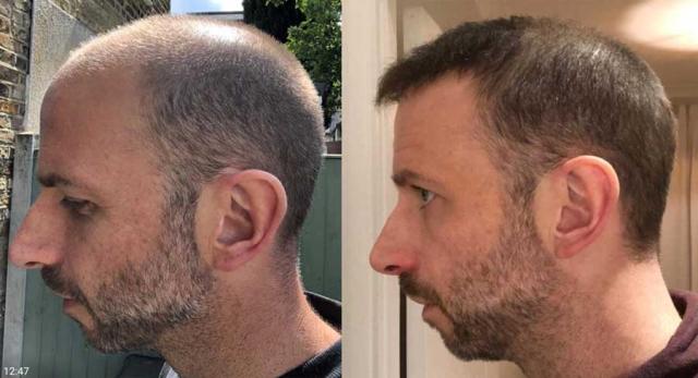 Left view before and after hair transplant surgery