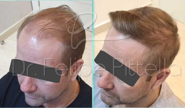 Left view before and after hair transplant surgery