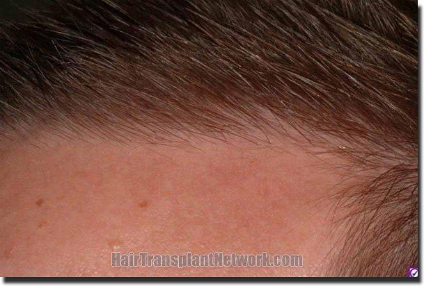 Hair restoration procedure results