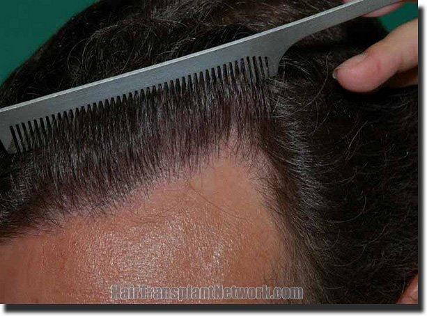 Hair restoration procedure results