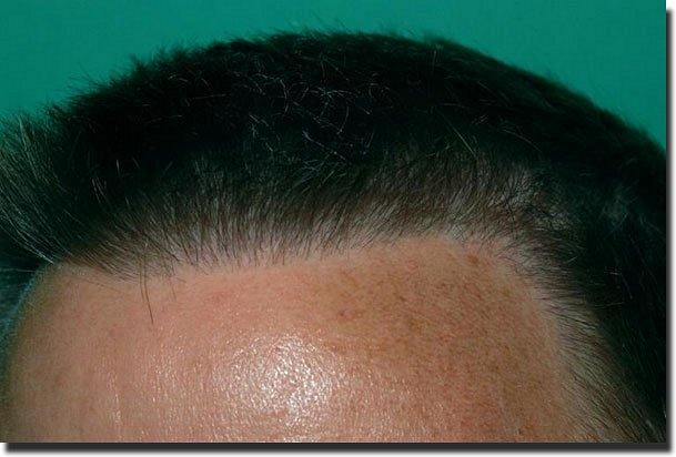 Hair restoration procedure results