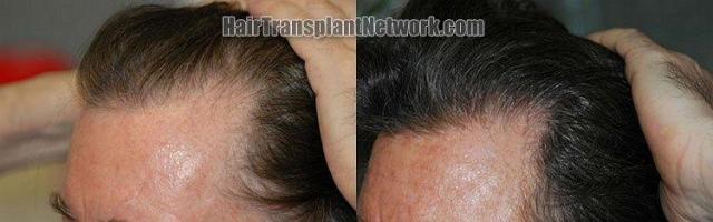 Left view of the hair transplant results