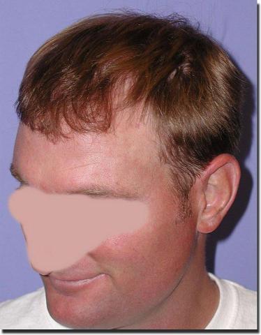 Hair restoration procedure results