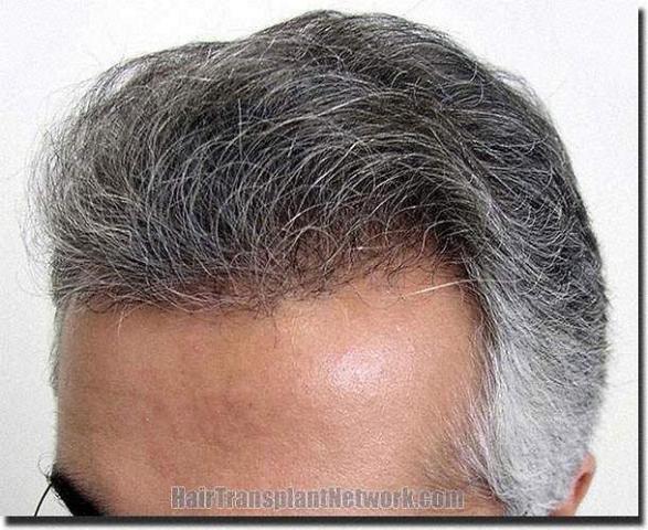 Hair restoration procedure results