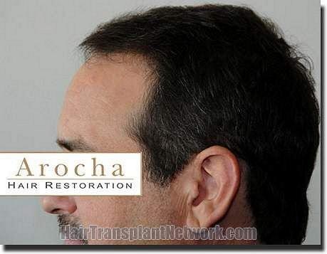 Hair restoration procedure results