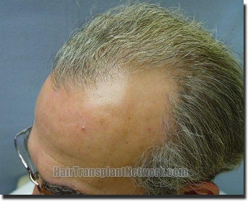 Hair restoration procedure results