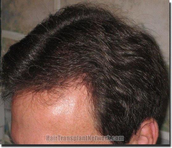 Hair restoration procedure results