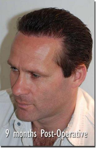 Hair restoration procedure results