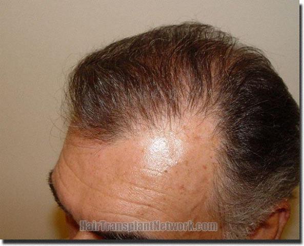 Hair restoration procedure results