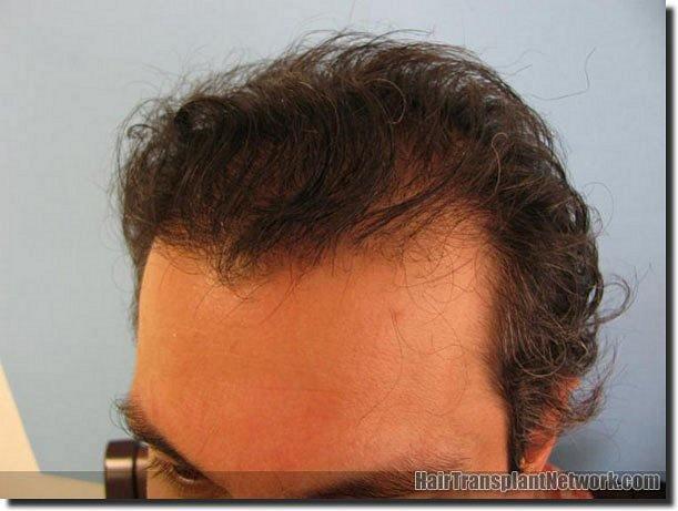 Hair restoration procedure results