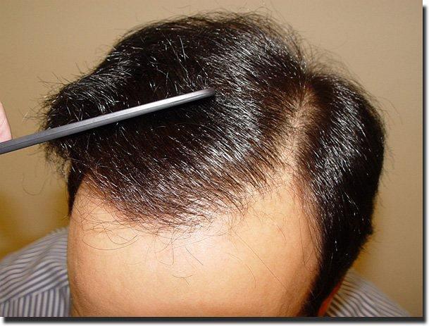 Hair restoration procedure results