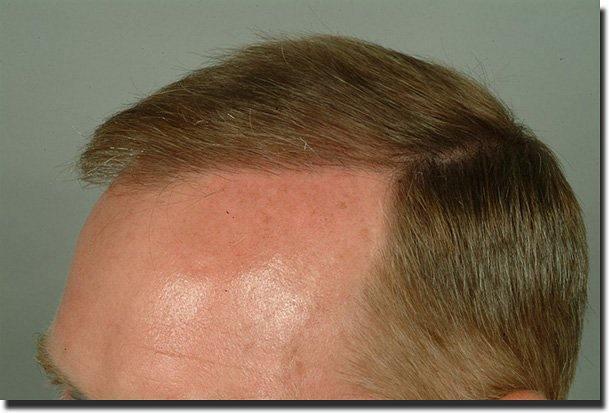 Hair restoration procedure results