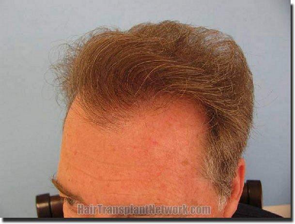 Hair restoration procedure results