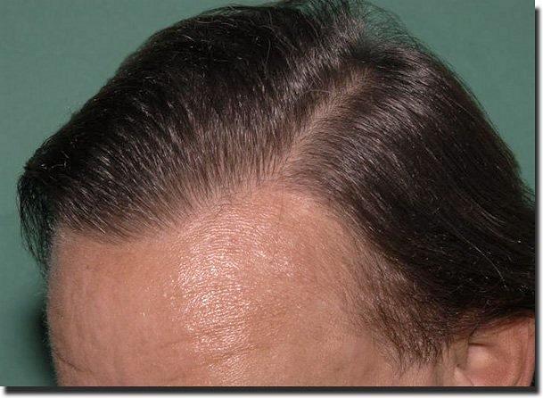 Hair restoration procedure results