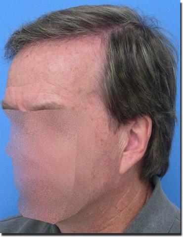 Hair restoration procedure results