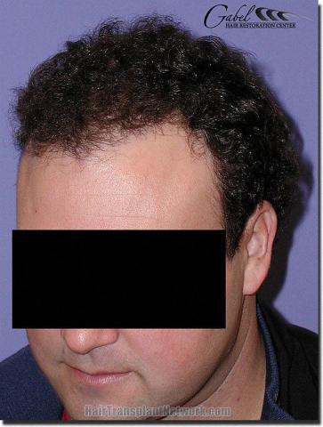 Hair restoration procedure results