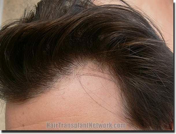 Hair restoration procedure results