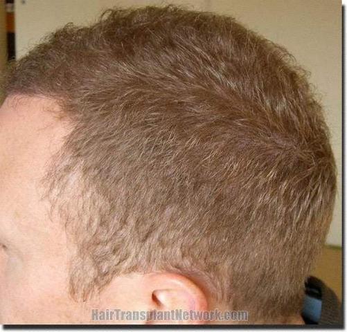 Hair restoration procedure results