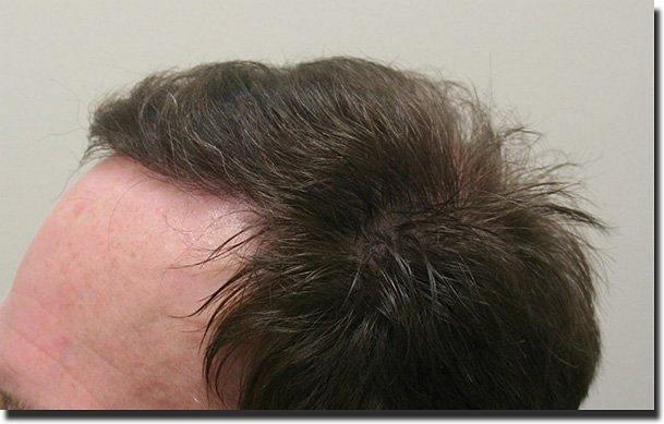 Hair restoration procedure results