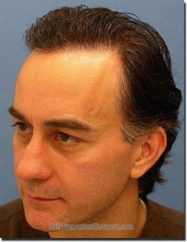 Hair restoration procedure results