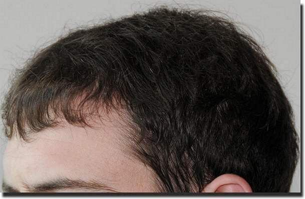 Hair restoration procedure results