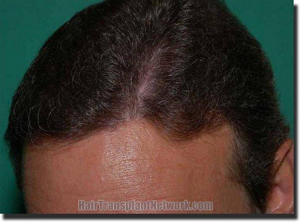 Hair restoration procedure results