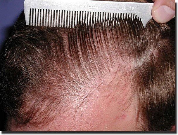 Hair restoration procedure results