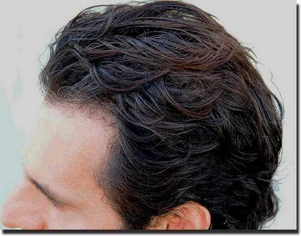 Hair restoration procedure results