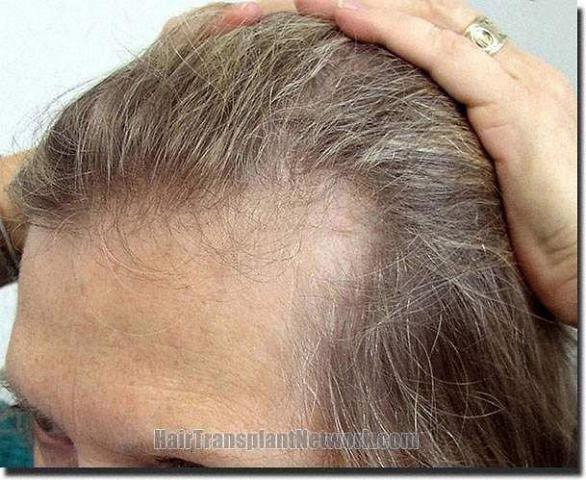 Hair restoration procedure results