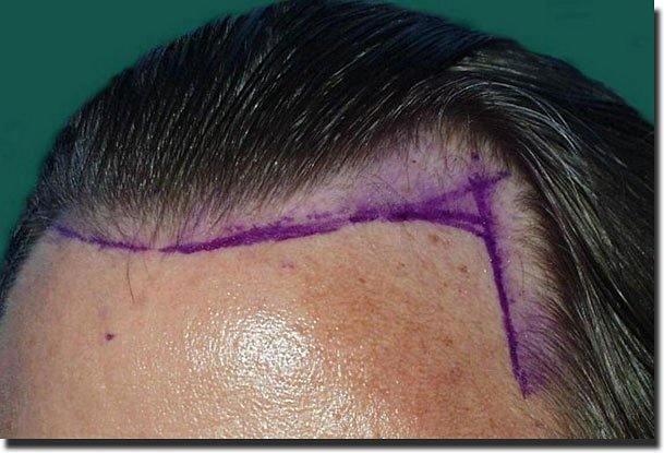 Hair restoration procedure results