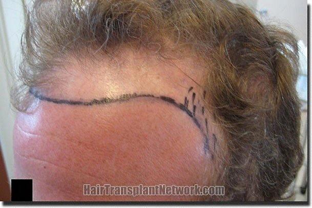 Hair restoration procedure results