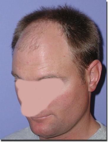 Hair restoration procedure results