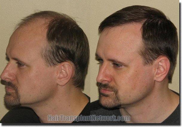 Hair restoration procedure results