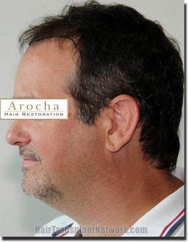 Hair restoration procedure results