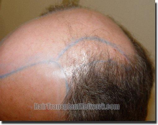 Hair restoration procedure results