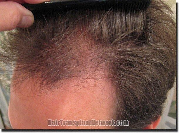 Hair restoration procedure results