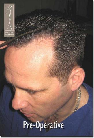 Hair restoration procedure results