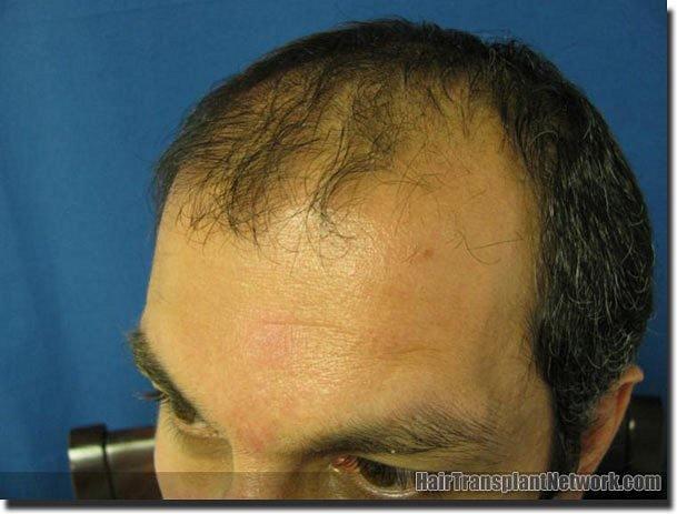 Hair restoration procedure results