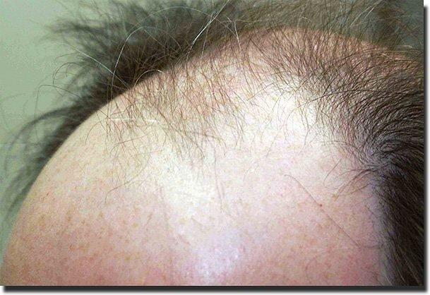 Hair restoration procedure results