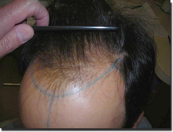 Hair restoration procedure results