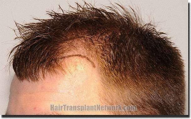 Hair restoration procedure results