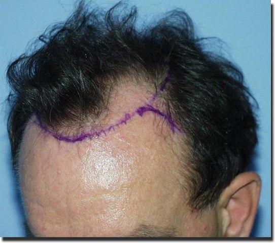 Hair restoration procedure results