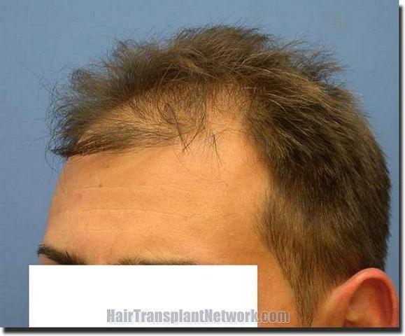 Hair restoration procedure results