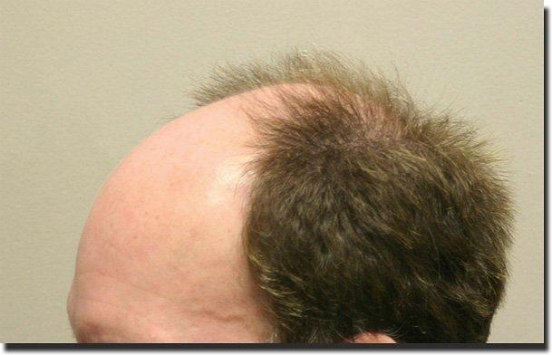 Hair restoration procedure results