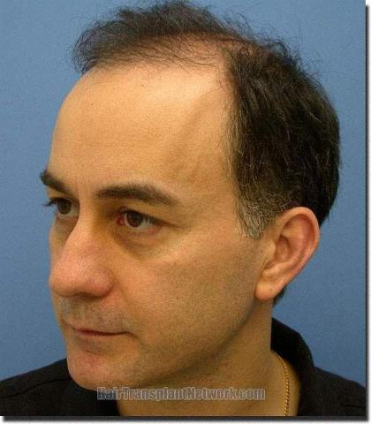 Hair restoration procedure results