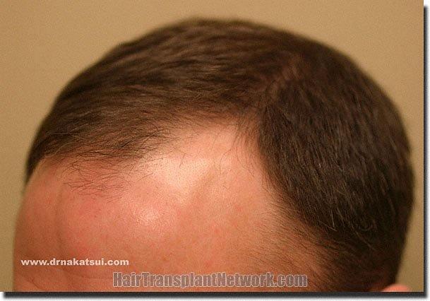 Hair restoration procedure results