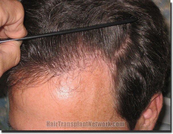 Hair restoration procedure results