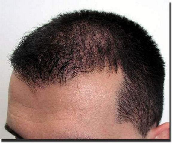 Hair restoration procedure results